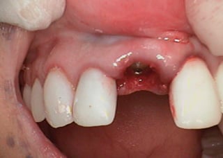 r14